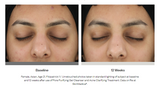 Acne Clarifying Treatment