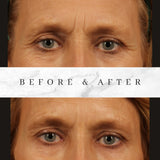 Bank Your Botox