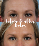 Bank Your Botox