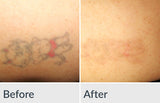 Tattoo Removal- 10% off treatments