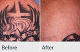 Tattoo Removal- 10% off treatments